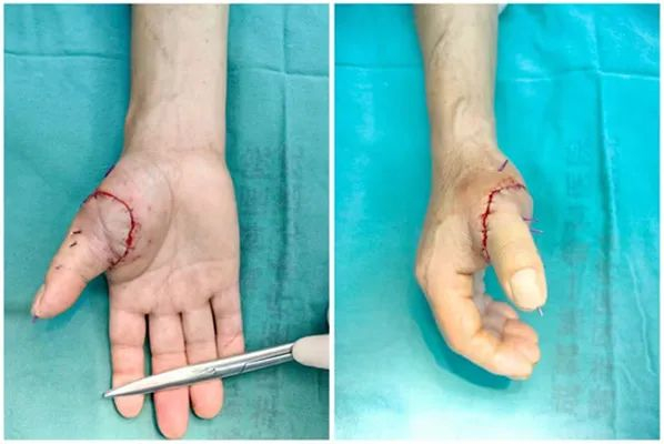 ▲伤者手术后的手部情况