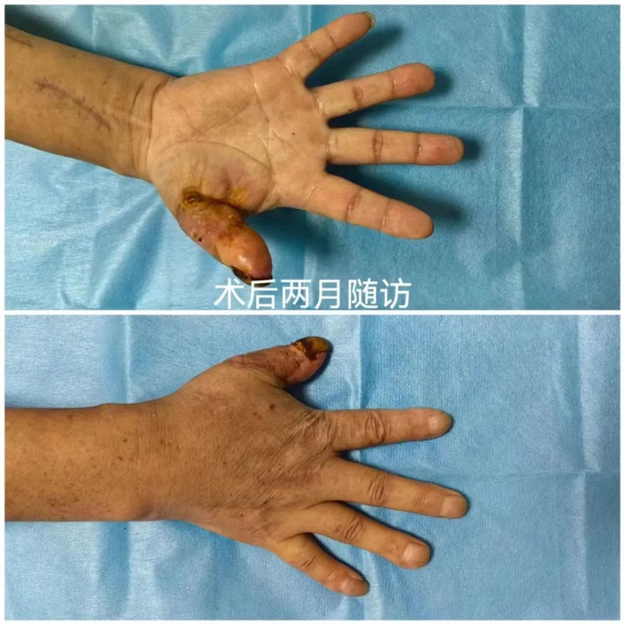 ▲伤者术后两个月复查情况
