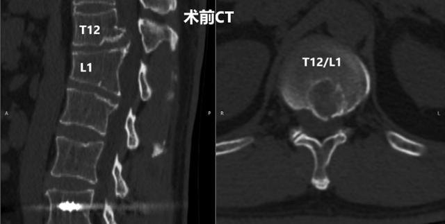 患者术前CT/图源 重医附二院