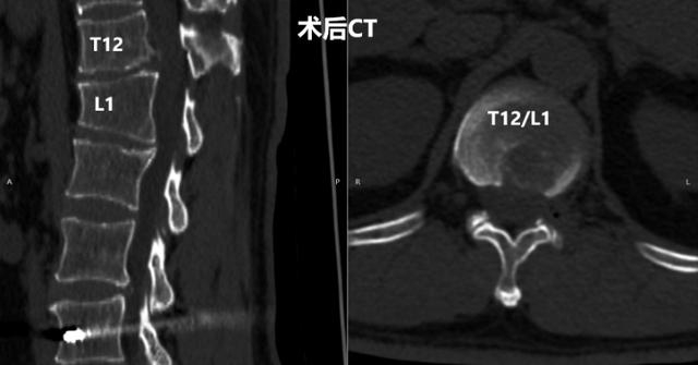 患者术后CT/图源 重医附二院