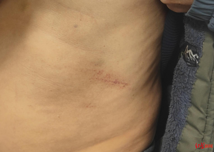 ▲杨某肋骨部位