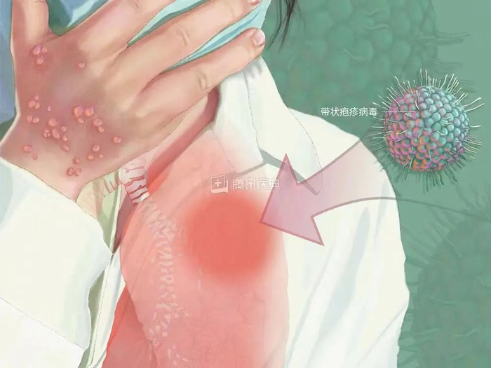 水痘肺炎｜图源：见水印