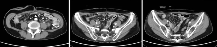 图4-6近期复查腹部CT图像，显示腹膜病变明显减少，腹水消失