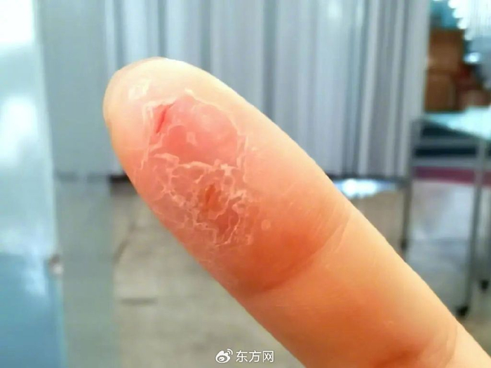 △记者在瑞幸咖啡工作期间，右手食指“烂手”最严重时（图片来源：记者）