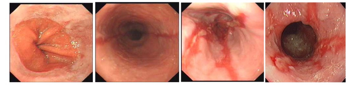 （图为各种胃镜下胃食管反流的表现，由轻 →→→→ 重）