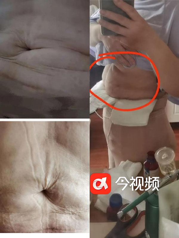 张女士腹部抽脂手术效果图