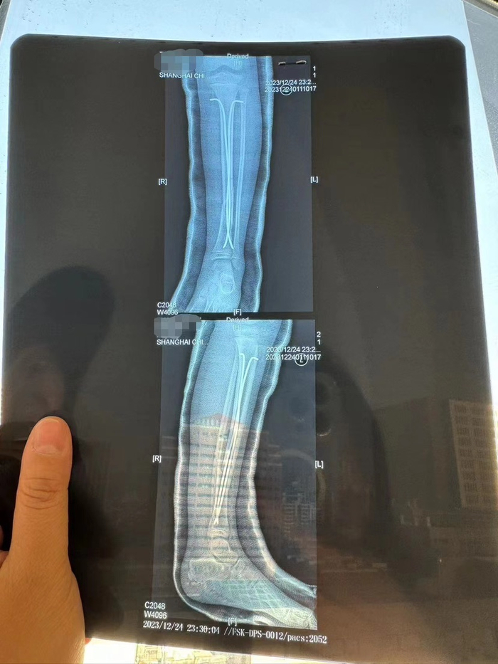 图说：事发当日乐乐做了6小时全麻手术，左腿植入了两根髓内钉。图源：受访者