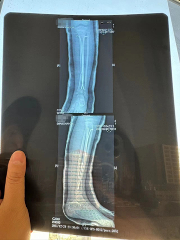 事发当日乐乐做了6小时全麻手术，左腿植入了两颗髓内钉。图源：受访者