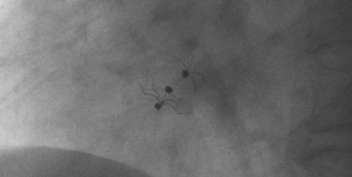 影像显示试验器械适应性贴合于房间隔两侧且稳定
