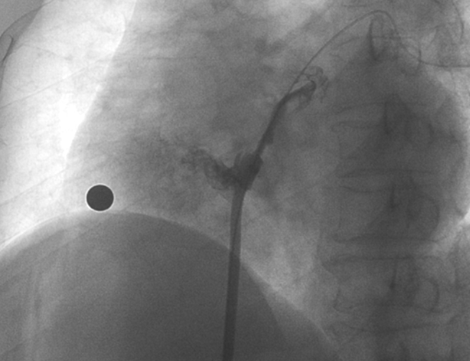 造影显示长隧道型PFO