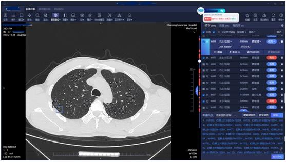 （肺结节人工智能筛查影像）