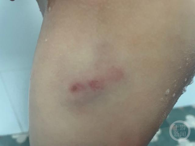 　4岁男童在小区内被无证犬只咬伤臀部。受访者供图