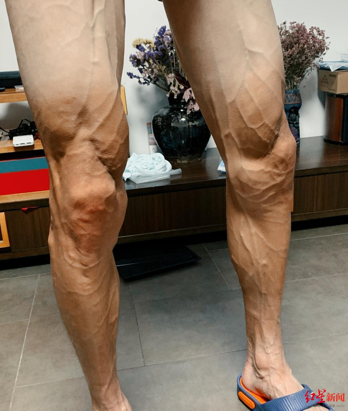 ▲小郭患进食障碍症期间的身材