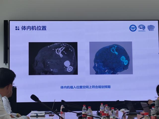 植入老杨脑内的脑机接口。  新京报记者 戴轩 摄