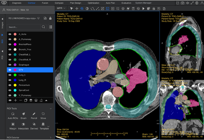 图：AI自动完成的放疗靶区勾画工作，红色为靶区，其他颜色为正常器官