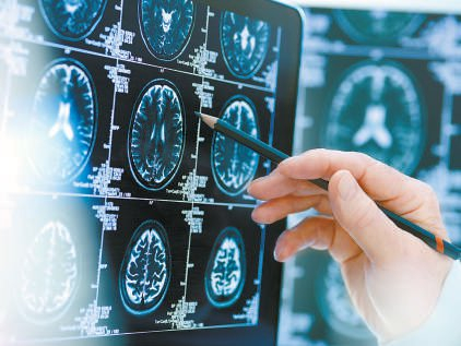 医生查看患者脑部扫描图