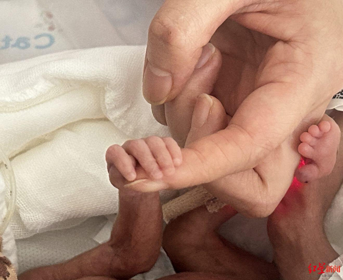 ▲刚出生的喜悦手臂只有成人手指大小