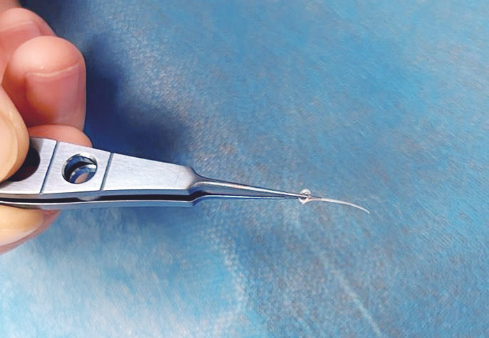     夹出的结膜吸吮线虫