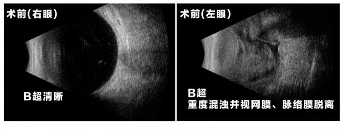 眼部B超检查图