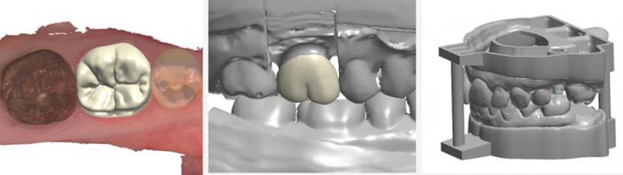 通过义齿设计软件制造齿冠和模型