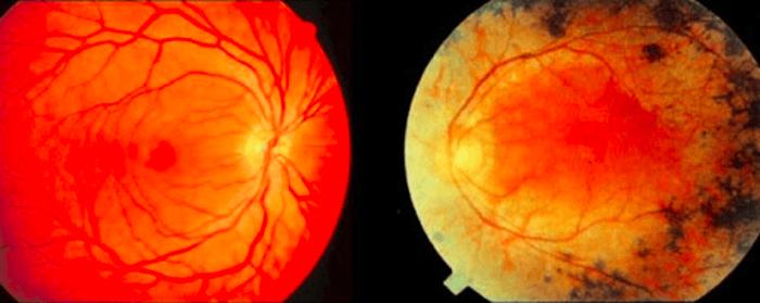 正常视网膜（左）和 RP 视网膜（右）的对比，后者为经典三联征 视网膜血管变细、视盘蜡样苍白及视网膜内骨针样色素沉着
