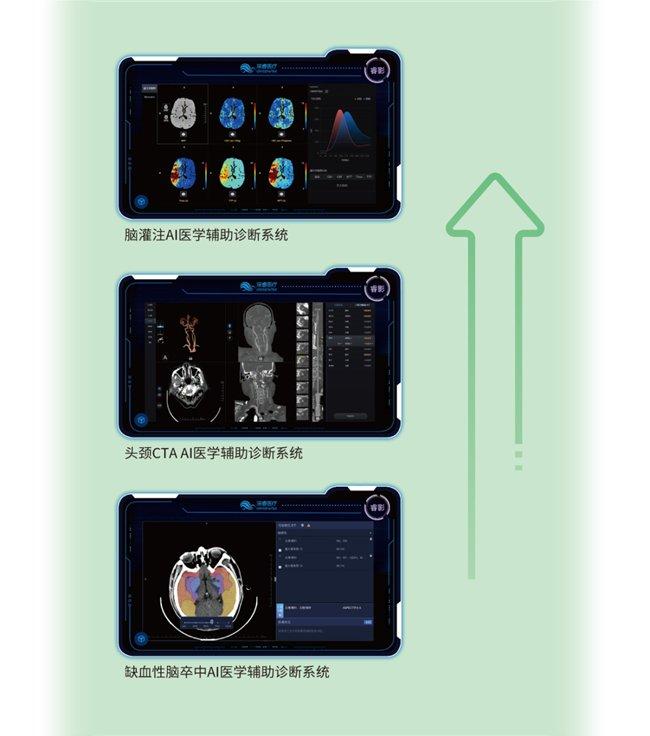 睿影一站式CT缺血性脑卒中智慧解决方案