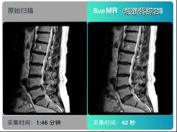 应用SupMR™前后的MRI影像对比