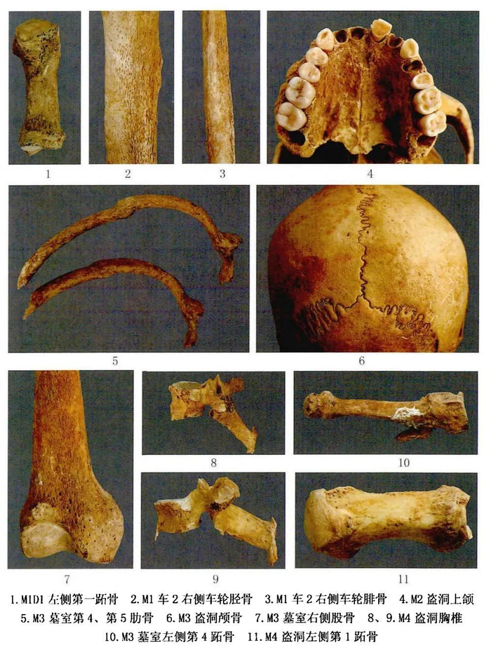 图三 后刘家塔商代人骨创伤与病理