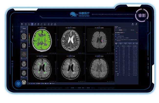 颅脑MR AI医学辅助诊断系统