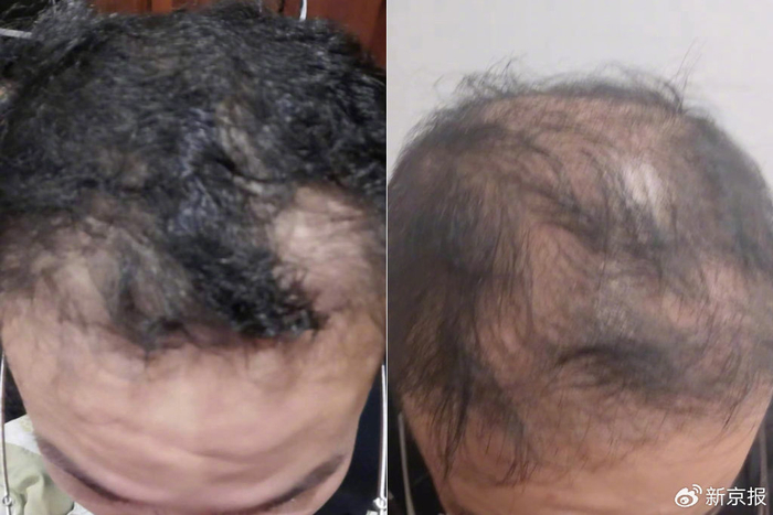 袁子义进行植发手术前后的头顶头发对比，左图拍摄于2022年1月初植发手术前，右图拍摄于2023年10月。 受访者供图