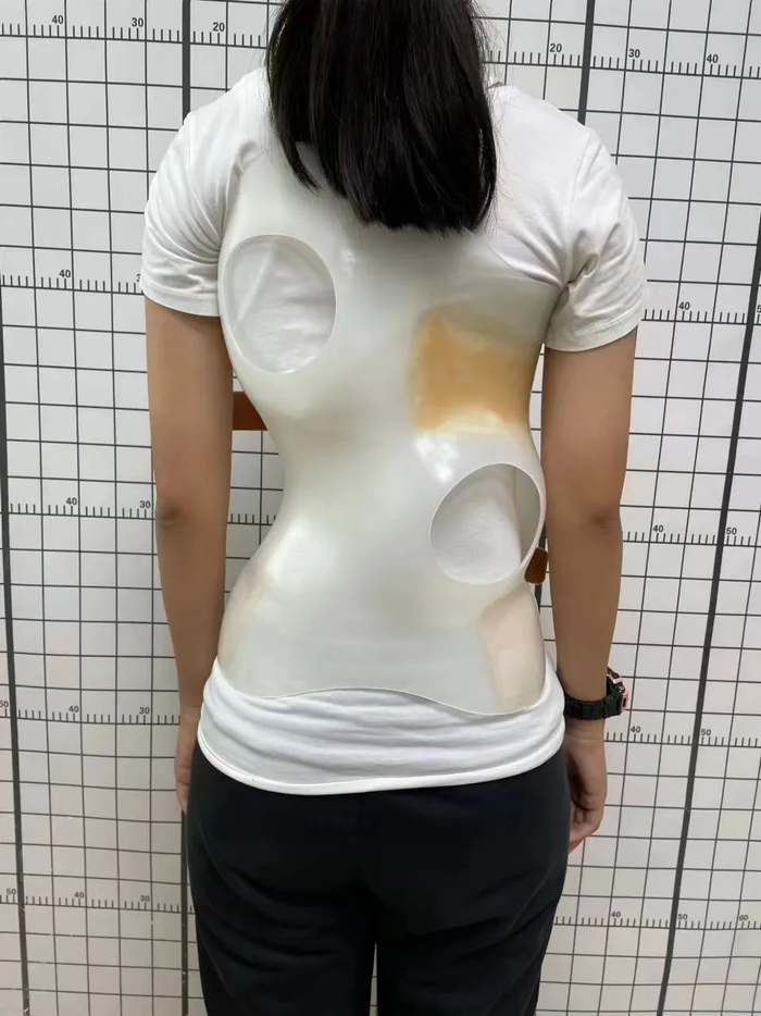 个性化定制支具作用：在脊柱生长时将脊柱保持在正确的位置。图源/南海人医