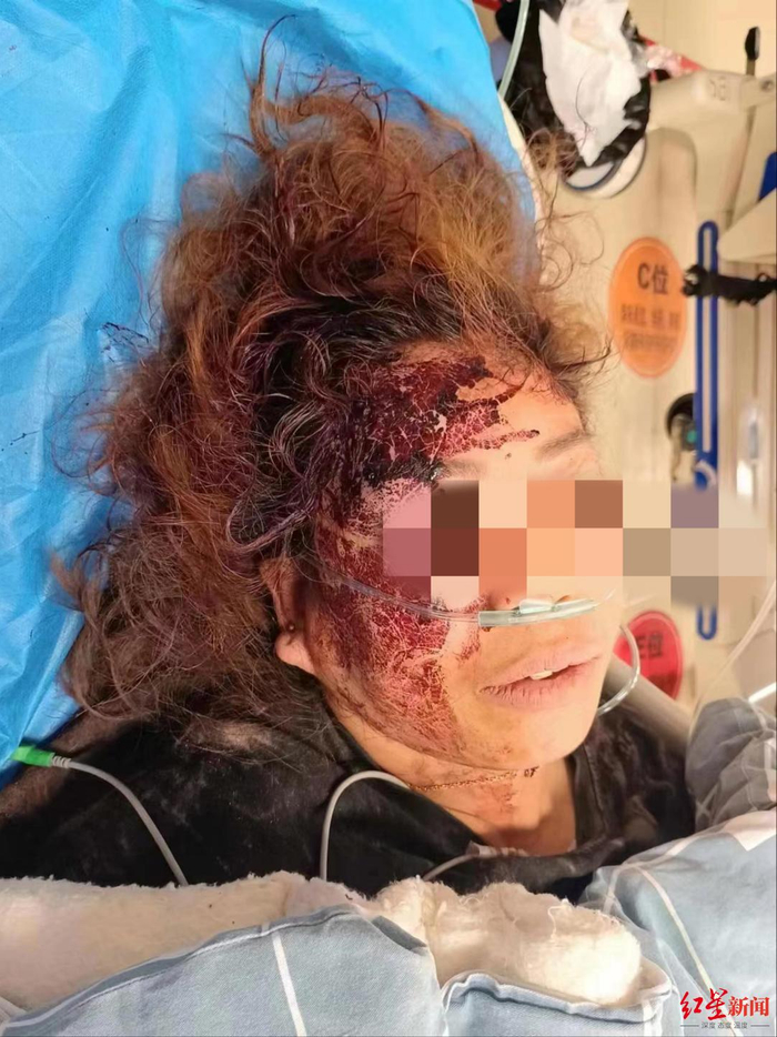 ▲徐女士被拳打脚踢后受伤
