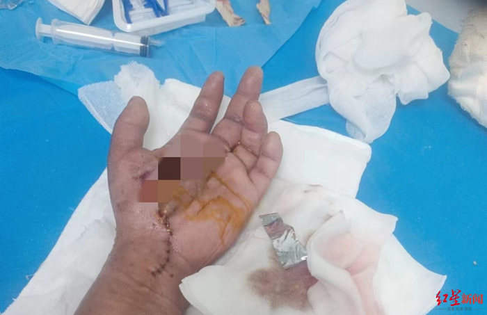 ▲吴先生受伤后伤口被缝合