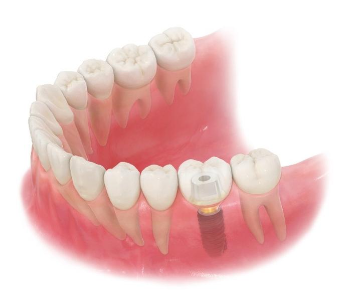 （图片说明）在缺牙位植入人工牙根后连接修复体，发挥自然牙的作用