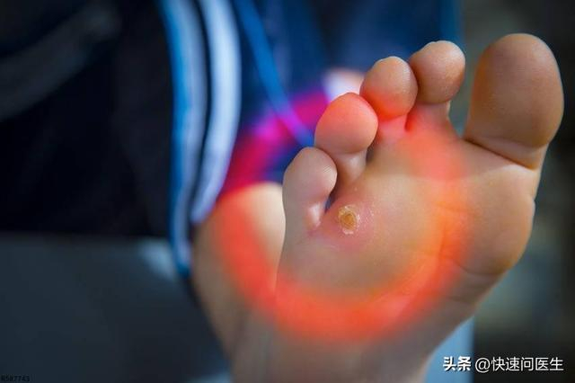 虽然趾疣也有可能会自愈,但这自愈的时间一般非常长,就算是小孩,自愈