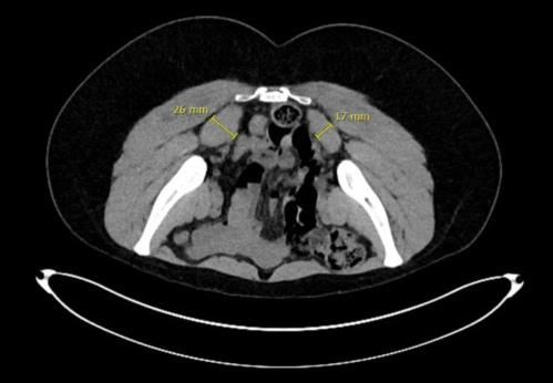 图：梨状肌综合征患者CT可发现双侧梨状肌不对称肥大