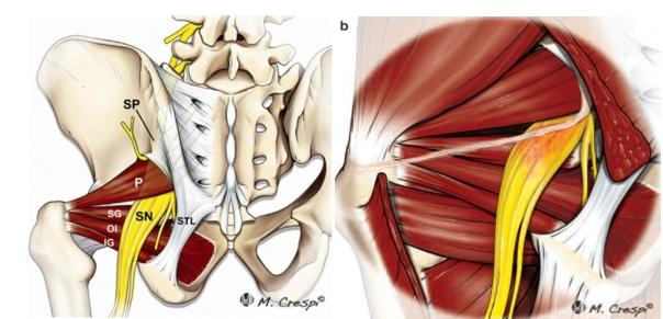 左图：正常的梨状肌和坐骨神经解剖（P：梨状肌 SN：坐骨神经）