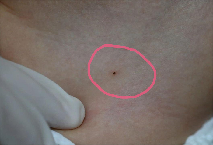 ▲被蜱虫叮咬后的小黑点