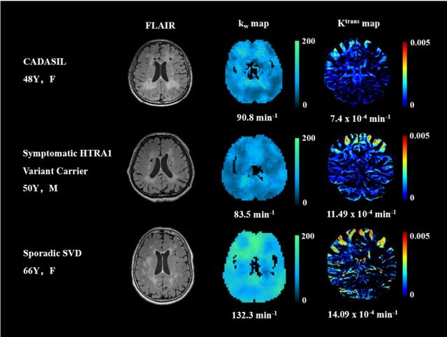 图1 三组cSVD的kw及Ktrans图示例