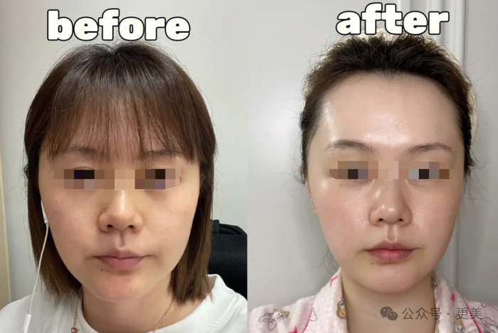 △超声炮效果，整体均匀的一个紧致上提