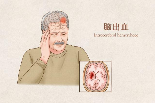 可能是脑出血,脑梗死,脑肿瘤,小脑病变等,造成小脑损害,引起小脑功能