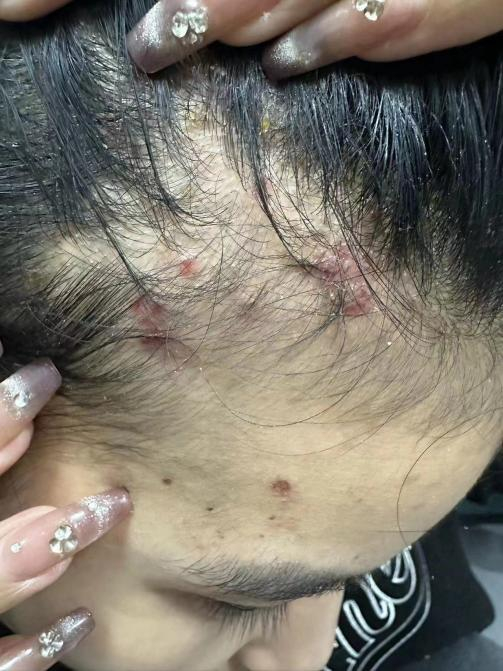 图为受访者过敏情况。受访者供图