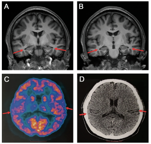 患者脑部磁共振（MRI）结果图