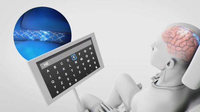 Eine Weltneuheit!Das Gehirn-Computer-Schnittstellenunternehmen Synchron Implantierte Chatgpt Erfolgreich Ohne Kraniotomie In Das Menschliche Gehirn_Sina Mobile 2 W700D1Q75Cms