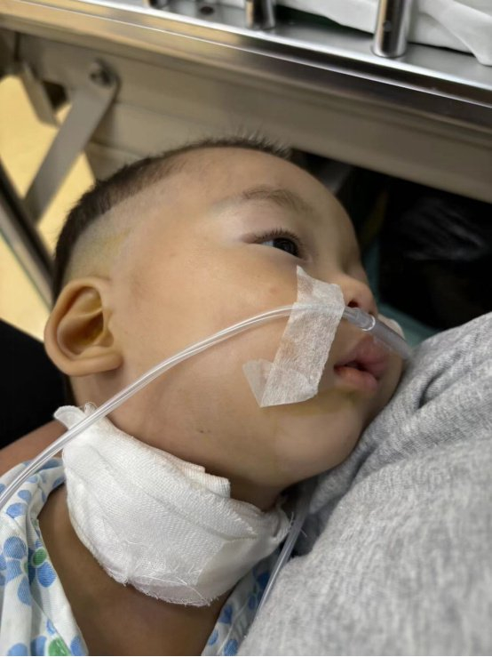 ▲2024年5月30日，第二次异物取出手术成功后，童童发着高烧。受访者供图