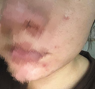 使用线上护肤老师售卖的产品后，姚晓涵面部开始长痘。受访者供图