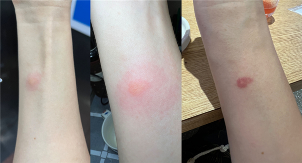 作者手臂被蠓咬的第1、2、3天。来源：作者拍摄