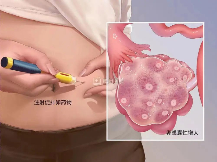 ▲卵巢过度刺激综合征（图源：腾讯医典）