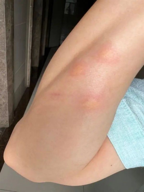 被咬的手臂。来源：作者拍摄