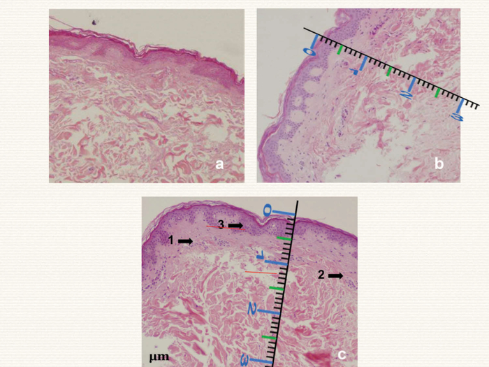 图1：可丽肤激光组织学效应观察。图片对应耳后区域的样本。需要澄清的是，本组织学图像不对应本研究中的病例。